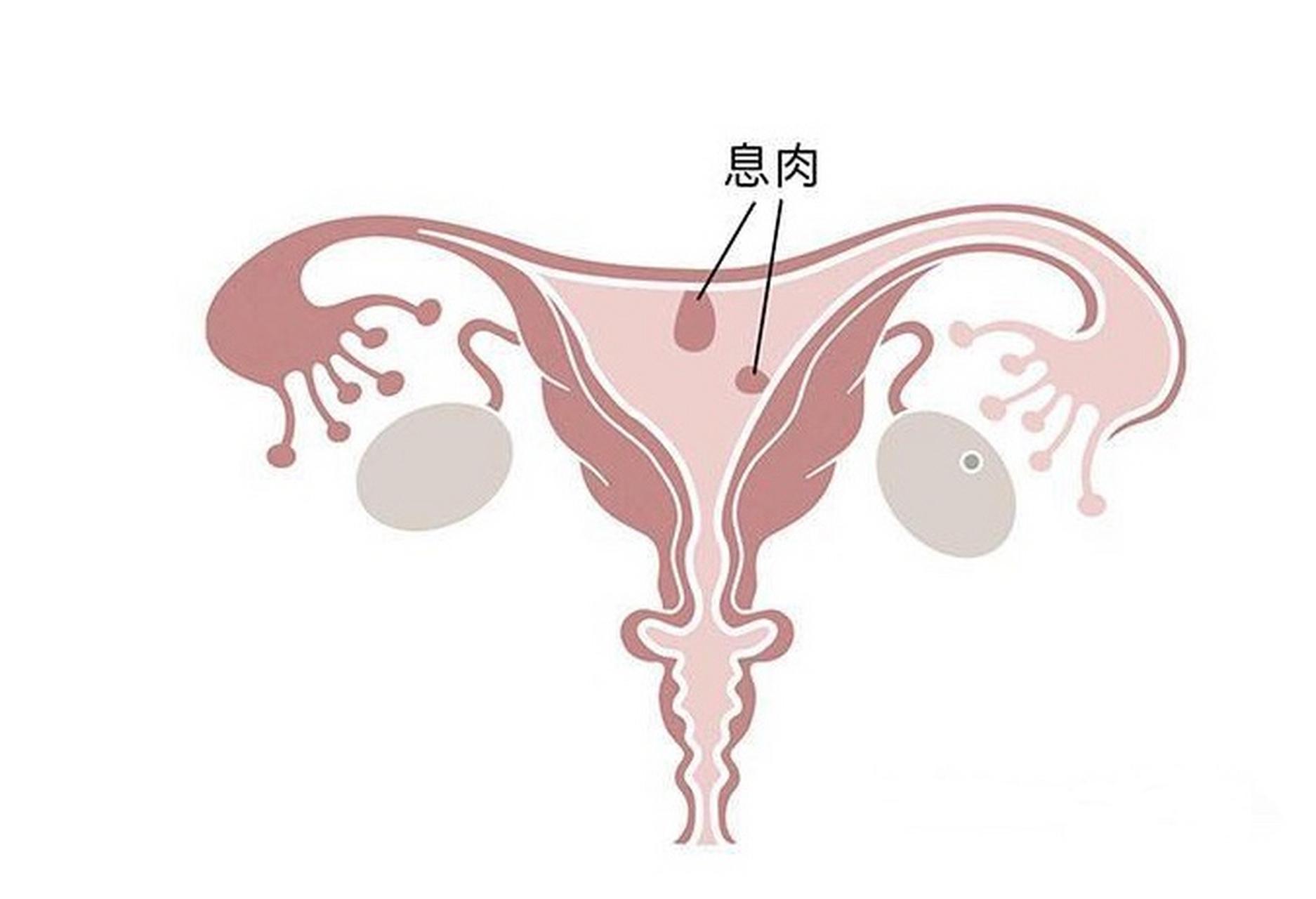 子宫里的“小肉坠” ：关于子宫内膜息肉，你需要知道的真相
